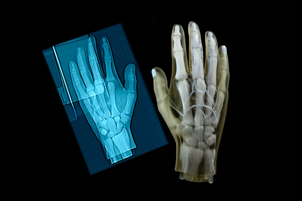 Hand Xray RadioMatrix PolyJet Medical Material